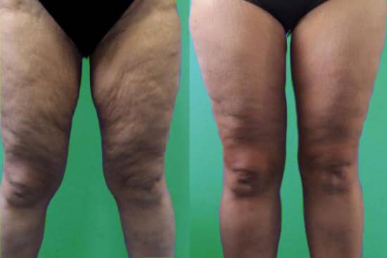 Lifting des cuisses Turquie